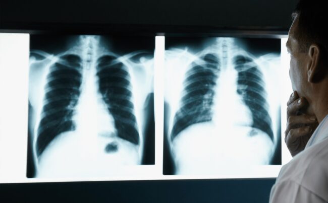 Akciğer Kanseri Akciğer Kanseri