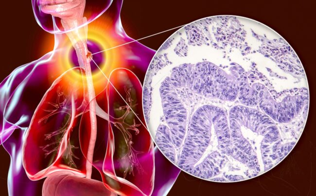 Yemek Borusu Kanseri Yemek Borusu Kanseri