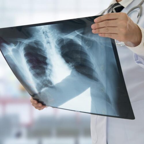 doctor-looking-at-lung-scan